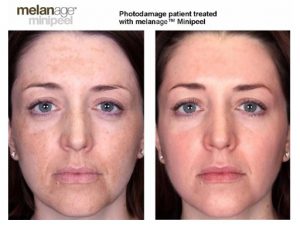 Melanage-Mini Before after